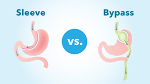 Bariatric-Surgery-comparison_1col.jpg