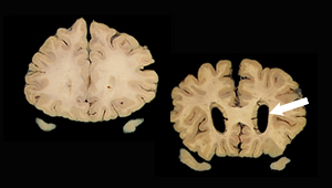 ATN brain scan image